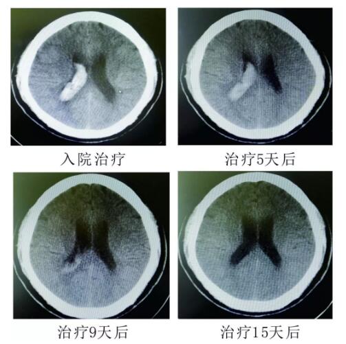 腦出血你不得不引起重視的疾?。。?！