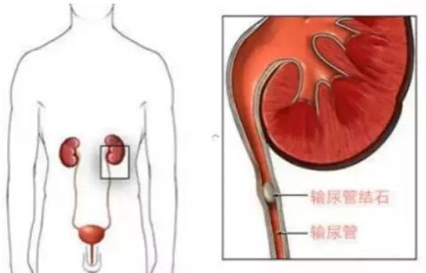 輸尿管結(jié)石，到底能不能保守治療？