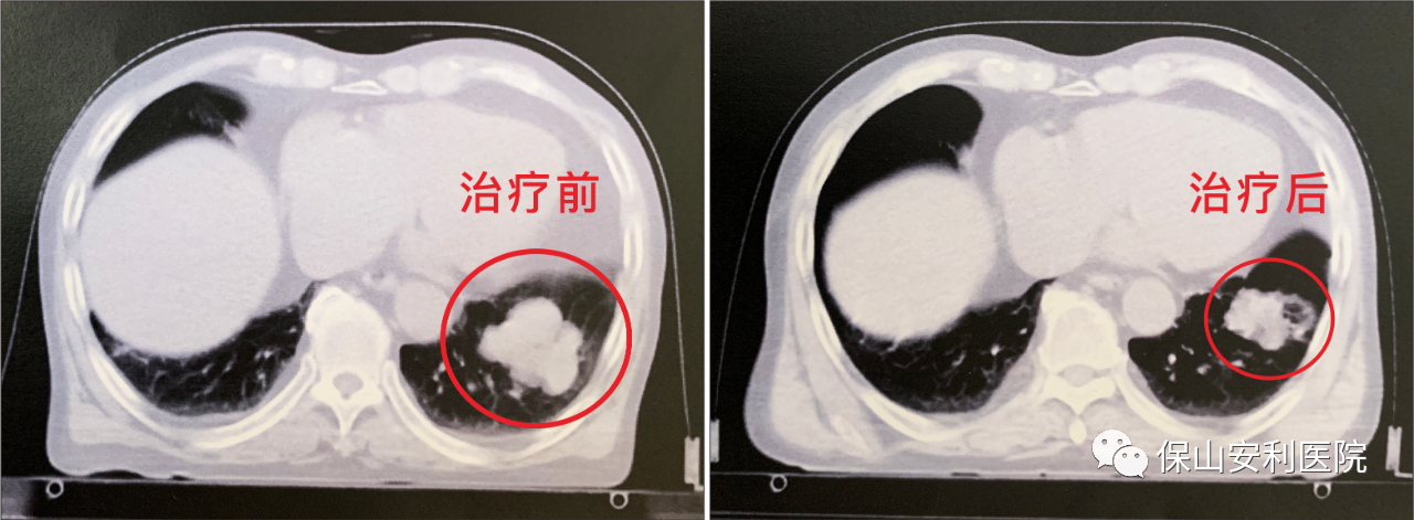 不做手術(shù)，早期肺癌也能根治！