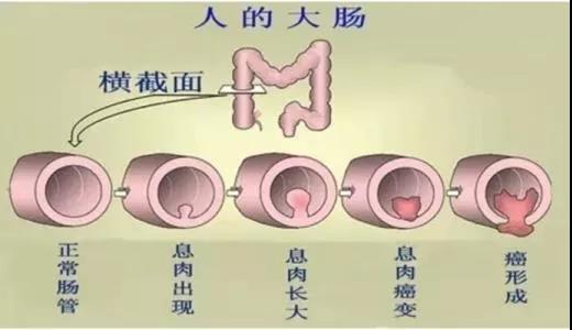 體檢發(fā)現(xiàn)腸息肉會(huì)癌變嗎？